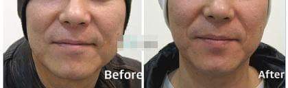 FB_IMG_1471483534374.jpg : 윤곽주사 맞은 어느 연예인