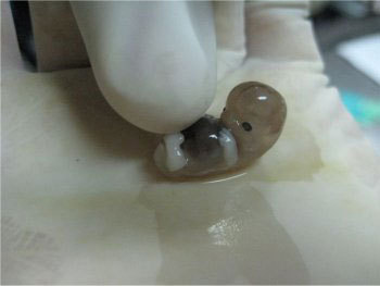 feto-4-.jpg : 초소형 태아